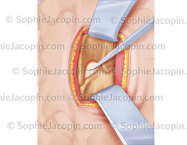 CHIRURGIE HERNIE DISCALE