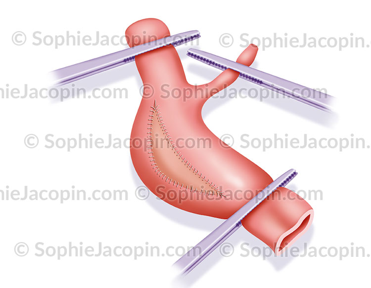 ENDARTERIECTOMIE