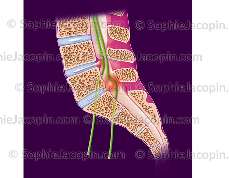 SCIATIQUE – Image 3
