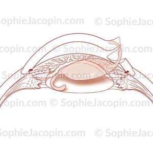 PHACOÉMULSIFICATION IMPLANT