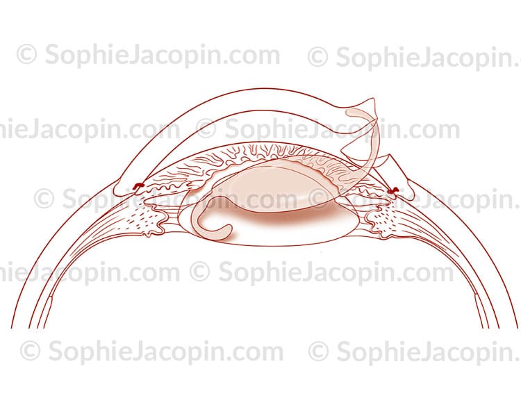 PHACOÉMULSIFICATION IMPLANT