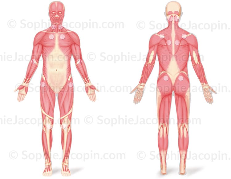 FIBROMYALGIE – Image 3