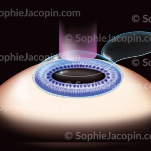 LASIK -LASER EXCIMER