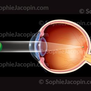ŒIL MYOPE